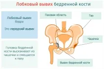става тазобедрената