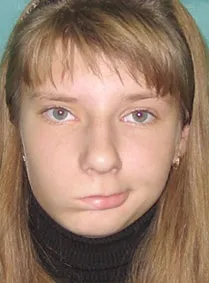 Защемлення лицевого нерва нерва