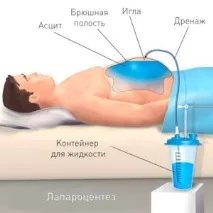 Асцит поняття, клініка, діагностика, лікування клініка