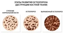 Чи дають інвалідність при остеопорозі ступеня присвоєння дають