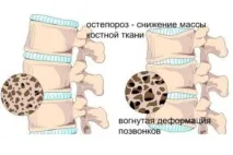Чи дають інвалідність при остеопорозі ступеня присвоєння ступеня