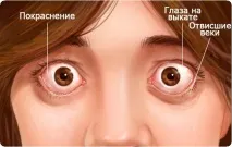 Ендокринна офтальмопатія – види, симптоми та лікування види