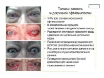 Ендокринна офтальмопатія – види, симптоми та лікування види