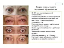 Ендокринна офтальмопатія – види, симптоми та лікування симптоми