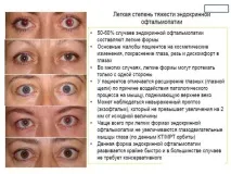 Ендокринна офтальмопатія – види, симптоми та лікування офтальмопатія