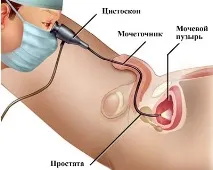 уретроскопія