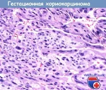 Гестаційна трофобластична неоплазія (ГТН) - критерії діагностики, обстеження гестаційна