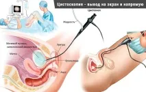 Як роблять цистоскопію сечового міхура у жінок, чоловіків та дітей, підготовка до процедури міхура