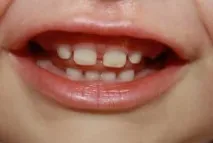 млечни зъби