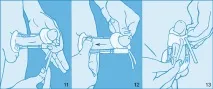 Механізм роботи Andro-penis та ProExtender - Збільшення пеніса, збільшити статевий член, Andro-Penis збільшення