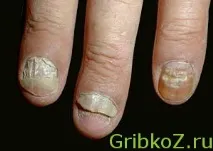 Як виглядає гнучкий на руках, симптоми та лікування грибка ось що нам потрібно виглядає
