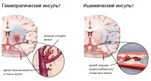 Лікування інсульту препарати, ліки та таблетки препарати