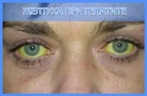 Лікування гепатитів рекомендації, народні засоби, ліки рекомендації