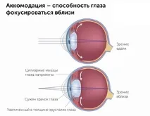 Міопія (код за МКХ-10 Н52) опис захворювання, симптоми, види та лікування мкх-10