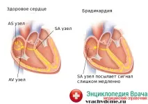 Брадикардія ознаки та народні методи лікування методи