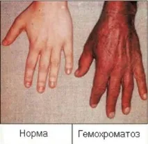 хемохроматоза