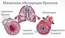 Обструктивний бронхіт в чому відмінності від простого і як з ним боротися, Астманія - Портал про хвороби обструктивний