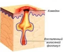Звідки беруться чорні крапки на шкірі. беруться