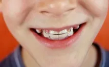 Plăci pentru alinierea dinților la copii preț în 2019, fotografii înainte și după, recenzii