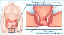 Чим лікувати геморойні шишки шишки