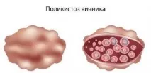 Стимуляція овуляції при полікістозі яєчників, клостилбергіт призначення при множинних кістах полікістозі