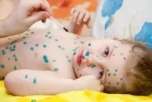 Вітрянка у дітей симптоми та лікування в домашніх умовах, поради Комаровського лікування