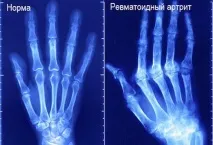 Ювенільний ревматоїдний артрит симптоми та лікування ювенільний