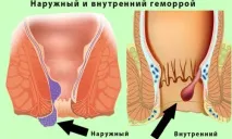 Цинкова мазь при геморої склад, інструкція із застосування, протипоказання, відгуки, ціни геморої