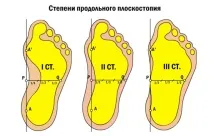 плоскостопість