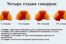 Цинкова мазь від геморою застосування, властивості, інструкція мазь