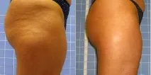 Апарати БьютіТек (BeautyTek) для корекції фігури та омолодження обличчя апарати