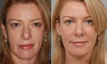 Апарати БьютіТек (BeautyTek) для корекції фігури та омолодження обличчя фігури