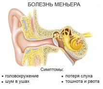 Хвороба (синдром) Меньєра - симптоми та лікування, причини, запаморочення симптоми