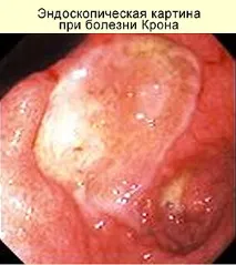 crohn болестта Crohn