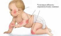 Екзема у дітей діагностика, симптоми, лікування та профілактичні заходи дітей