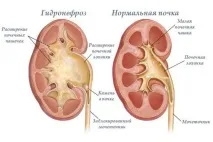 Гідронефроз нирки симптоми їх діагностика та лікування діагностика