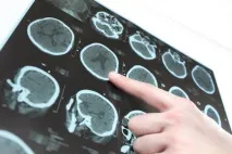 Лікування та відновлення після інсульту - стовбурові клітини як метод реабілітації після удару відновлення
