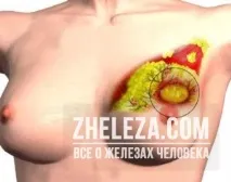 Мастопатія які препарати та лікування для цього використовуються «Домашні» методи лікування