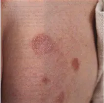 MY DERMATOLOGY тижнів