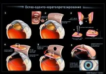 Остео-одонто-кератопротезування (пересадка зуба в око) пересадка