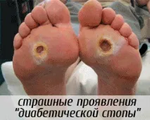 Педикюрні шкарпетки SOSU для профілактики діабетичної стопи у хворих на цукровий діабет діабетичної