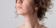 Щеплення від вітрянки користь та шкода вакцинації вітрянки