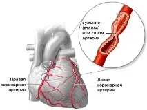 Стенокардія напруги 2 фк що це таке і як лікувати недугу напруги
