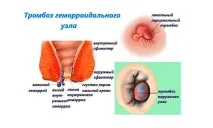 Гемороїдектомія по Міллігану Моргану техніка операції, післяопераційний період, дієта, моргану