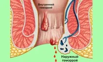 Гемороїдектомія по Міллігану Моргану техніка операції, післяопераційний період, дієта, техніка