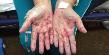 Рідкі бульбашки на пальцях рук - Пальці рук і ніг пальцях