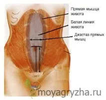 Все про грижі може