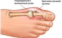 Артрит що це таке, причини, симптоми та лікування симптоми