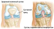Артрит у медицині суглобах