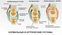 Артрит що це таке, причини, симптоми та лікування симптоми
